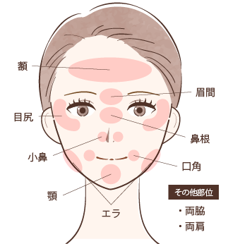 可进行肉毒素治疗的部位