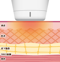 RF（ラジオ高周波）