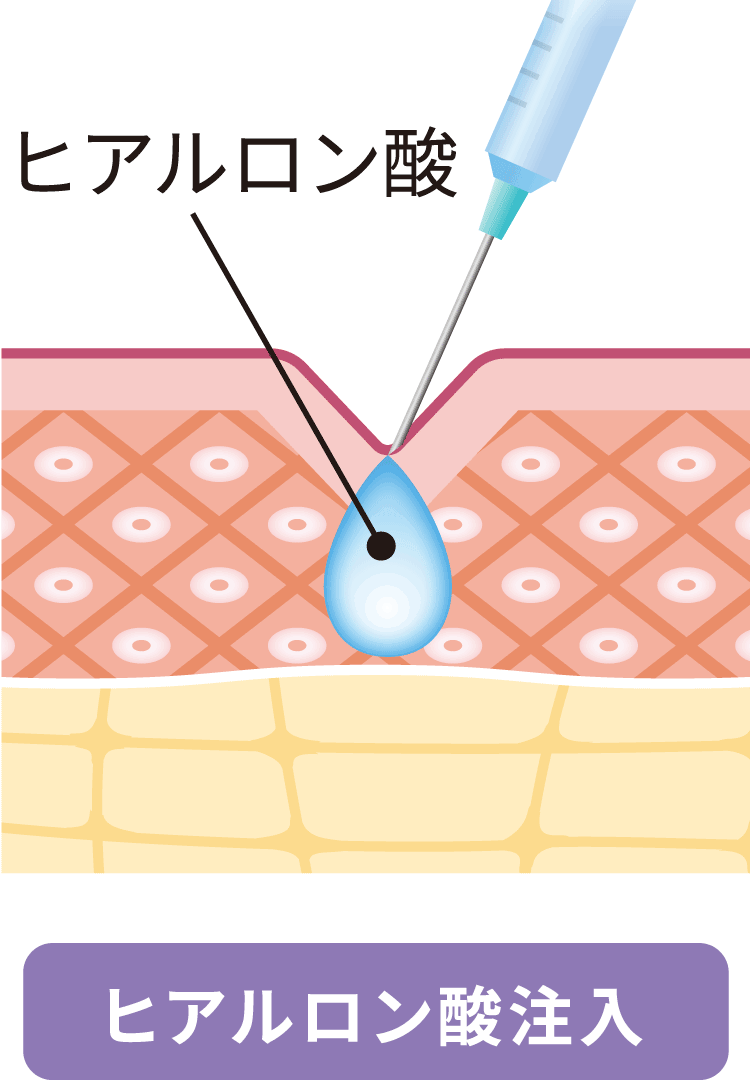 2.ヒアルロン酸注入