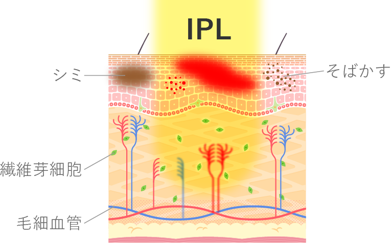 IPLのメカニズム図解