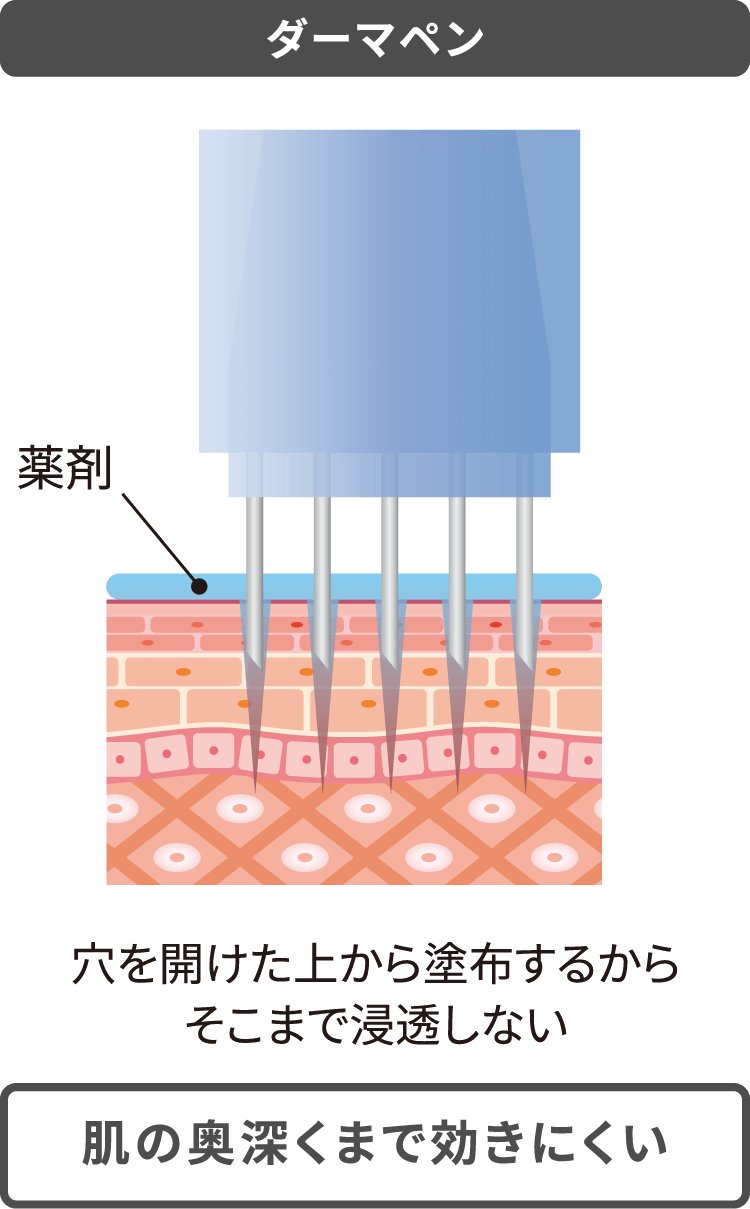 ダーマペン