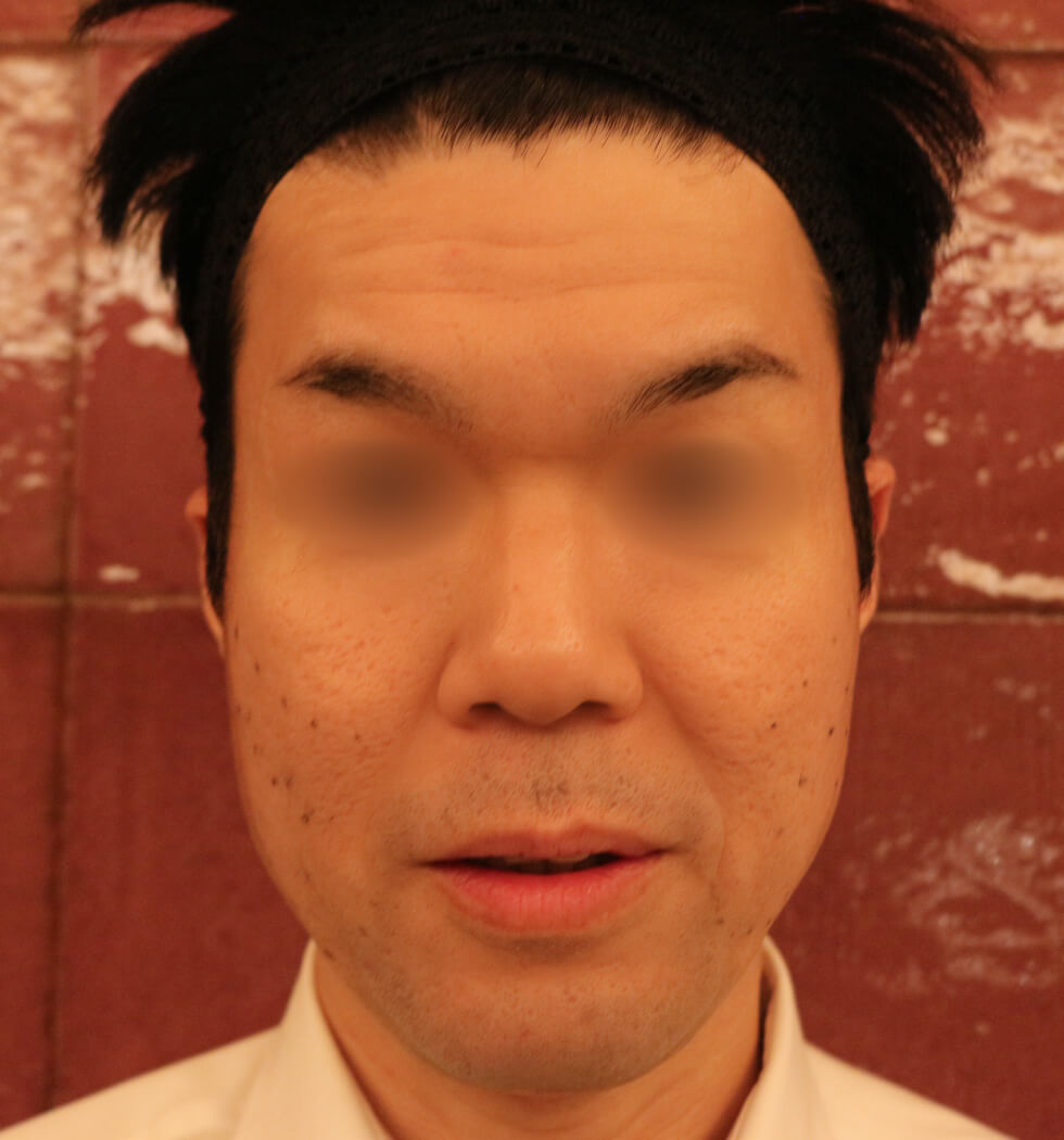 糸リフト（スレッドリフト）の症例写真　before