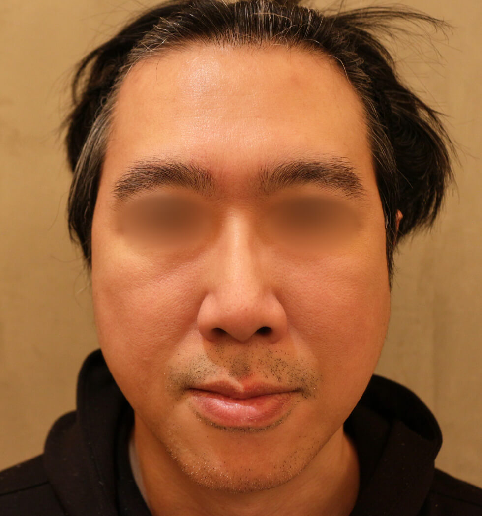糸リフト（スレッドリフト）の症例写真　after