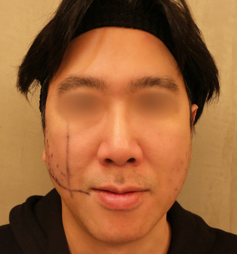 糸リフト（スレッドリフト）の症例写真　before