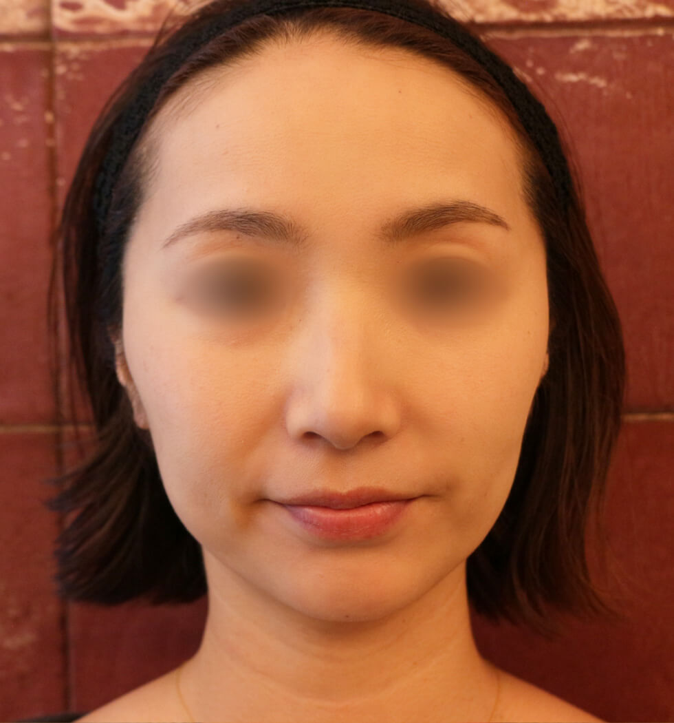 糸リフト（スレッドリフト）の症例写真　after