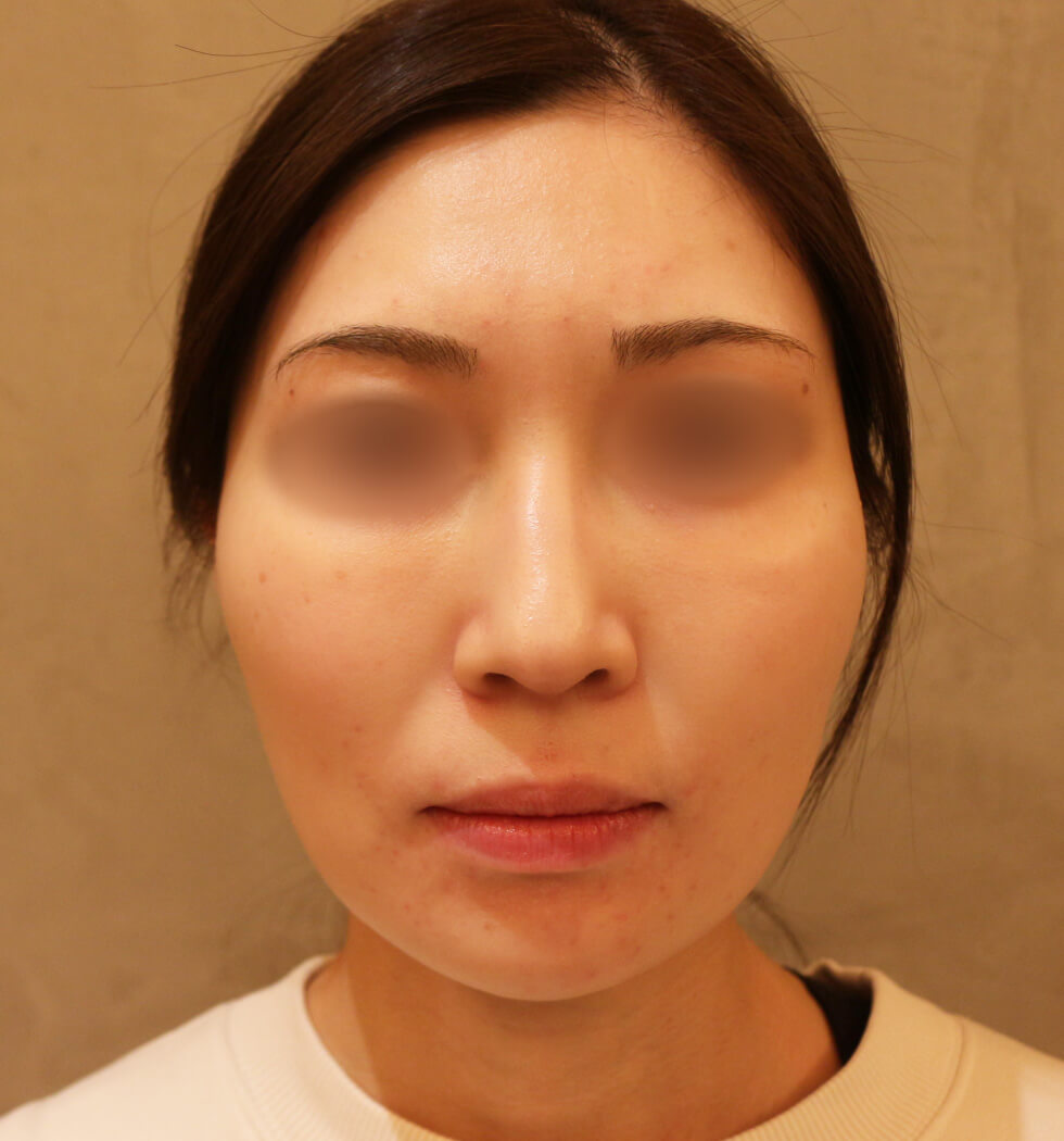 糸リフト（スレッドリフト）の症例写真　before