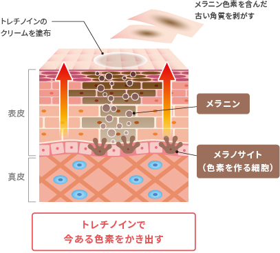トレチノイン治療の効果