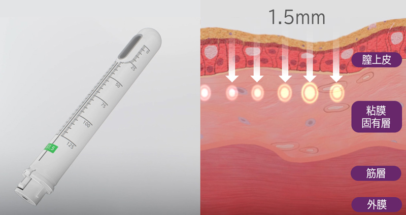 膣壁の表層（浅い層）にアプローチします。