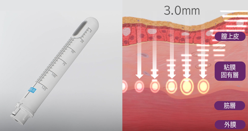 膣壁の中間層にアプローチします。