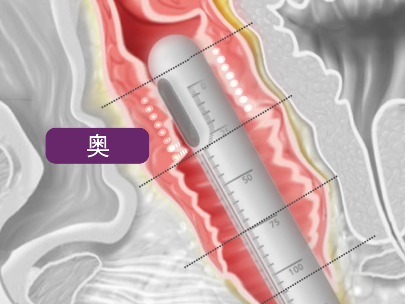 膣HIFU：ウルトラヴェラの照射範囲の奥