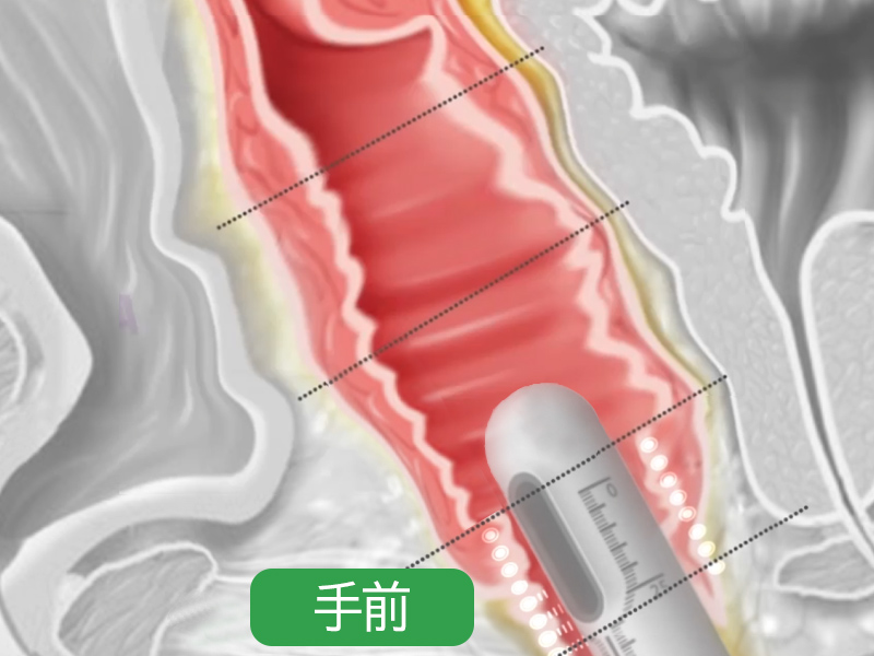 膣HIFU：ウルトラヴェラの照射範囲の全面